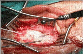 mastoidectomy